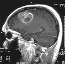 brain tumor